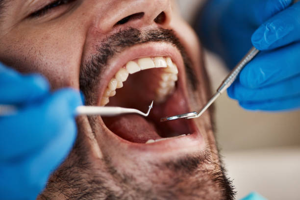 Best Emergency Dental Extractions in Hickory Hls, IL